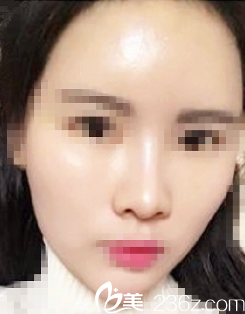 術(shù)后一周自體脂肪填充全臉