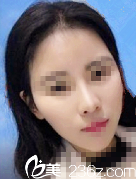 韓國延世Plus整形外科醫(yī)院徐東皖院長做自體脂肪填充面部怎么樣？真人案例