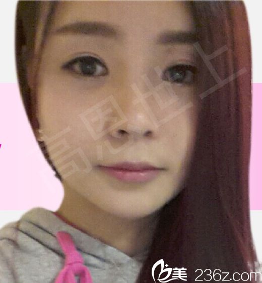 妹子在韓國(guó)德麗珍找趙胄元院長(zhǎng)做完雙眼皮和面部輪廓后是不是太驚艷了