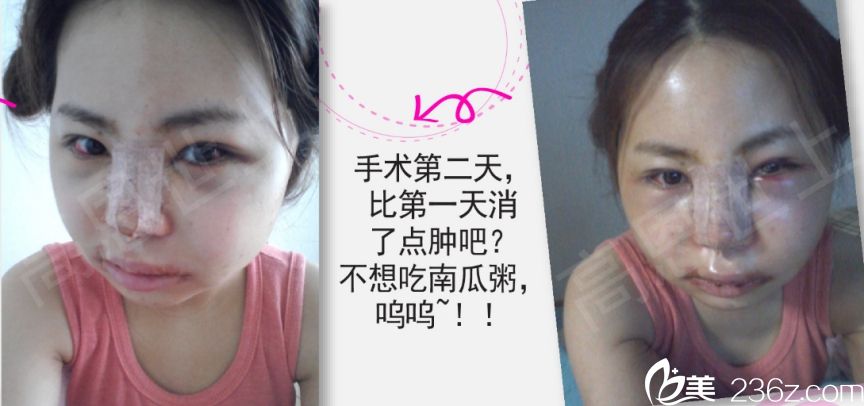 韓國高恩世上整形外科雙眼皮真人<span style=