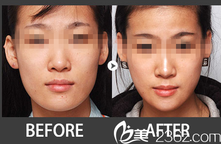 林平珍院長下顎整形真人案例 林平珍院長下顎整形真人案例