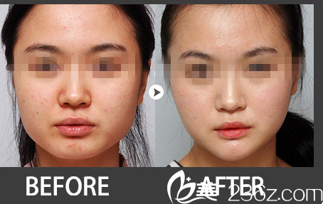 林平珍下顎整形前后 林平珍下顎整形前后