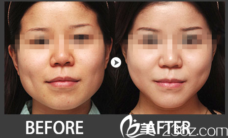 韓國嫵麗整形外科下顎整形對比圖 韓國嫵麗整形外科下顎整形對比圖