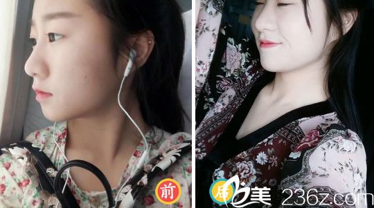 寧波薇琳<!--<i data=20240703-sp></i>-->注射玻尿酸豐下巴案例 寧波薇琳<!--<i data=20240703-sp></i>-->注射玻尿酸豐下巴案例