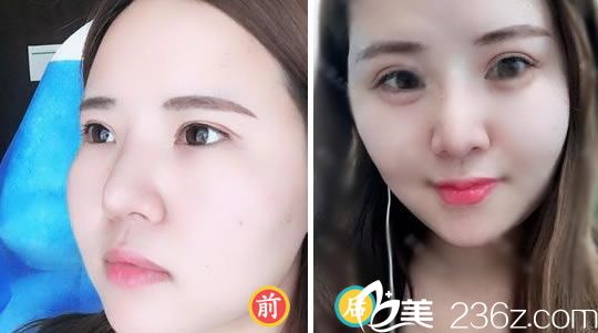 薇琳<!--<i data=20240703-sp></i>-->注射玻尿酸填充臥蠶案例 薇琳<!--<i data=20240703-sp></i>-->注射玻尿酸填充臥蠶案例