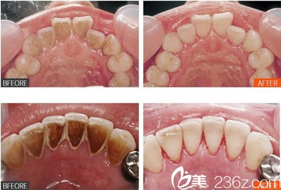 寧波薇琳范國文超聲波潔牙案例 寧波薇琳范國文超聲波潔牙案例