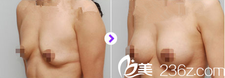 金允石院長矯正下垂胸部真人案例 金允石院長矯正下垂胸部真人案例