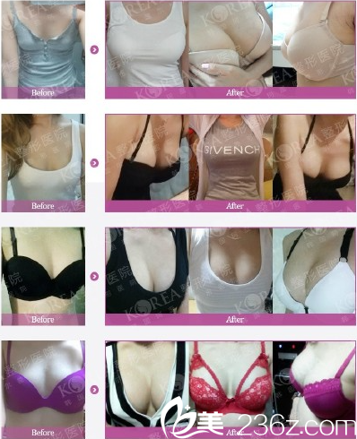 KOREA整形三無(wú)立體隆胸真人案例 KOREA整形三無(wú)立體隆胸真人案例