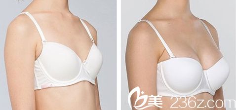 金允石院長假體隆胸前后對比圖 金允石院長假體隆胸前后對比圖