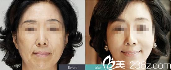 面部提升前后對(duì)比圖 面部提升前后對(duì)比圖