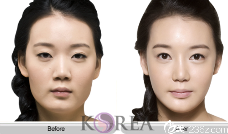 韓國KOREA整形崔相錄院長Vline案例 韓國KOREA整形崔相錄院長Vline案例