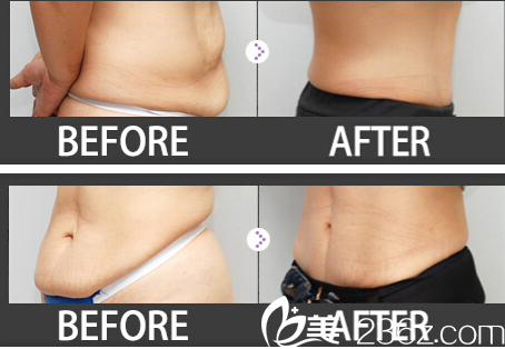 姜民赫院長腹部吸脂手術(shù)真人案例 姜民赫院長腹部吸脂手術(shù)真人案例