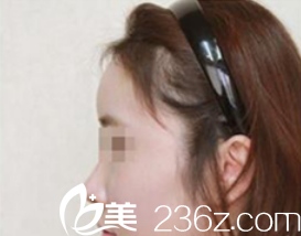 在韓國(guó)ISTAR整形外科做自體脂肪豐額頭，李相珉院長(zhǎng)案例