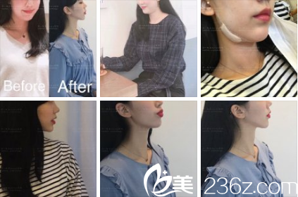 KOREA整形外科張瑞允下巴吸脂+提升 KOREA整形外科張瑞允下巴吸脂+提升