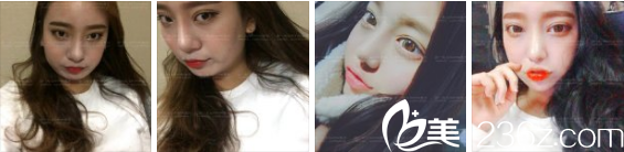 張瑞允院長開眼角+面部輪廓手術(shù) 張瑞允院長開眼角+面部輪廓手術(shù)