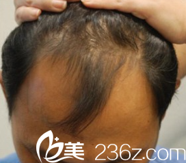 韓國狎鷗亭延世醫(yī)院脫發(fā)案例 韓國狎鷗亭延世醫(yī)院脫發(fā)案例