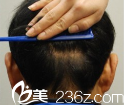 韓國狎鷗亭延世醫(yī)院毛發(fā)移植術(shù)后 韓國狎鷗亭延世醫(yī)院毛發(fā)移植術(shù)后