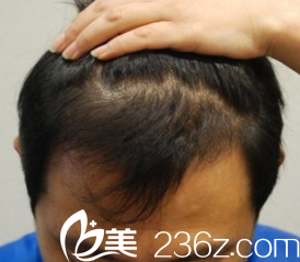 金大溶院長毛發(fā)移植術(shù)后5個月 金大溶院長毛發(fā)移植術(shù)后5個月