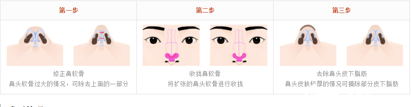 鼻頭軟骨整形手術(shù)過程 鼻頭軟骨整形手術(shù)過程