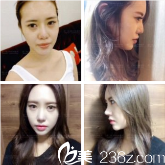 KOREA整形鼻整形案例 KOREA整形鼻整形案例