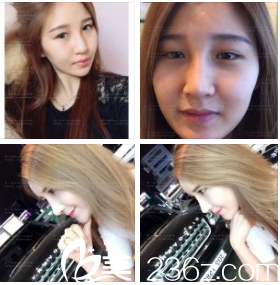 金享俊院長鼻部整形真人案例 金享俊院長鼻部整形真人案例