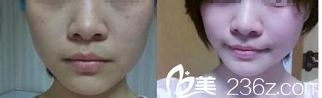   韓國(guó)格瑞絲整形外科皮膚科鄭賢旭祛斑效果怎么樣？激光祛斑真人案例