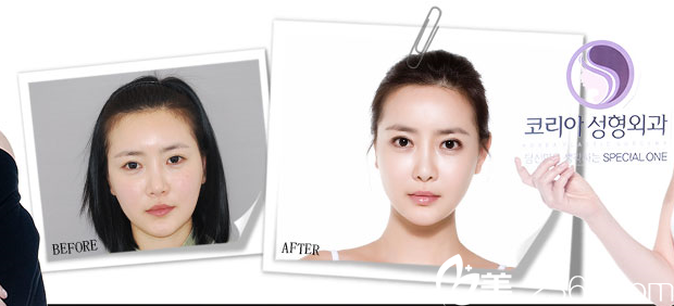 韓國(guó)KOREA整形外科申承翰真人案例 韓國(guó)KOREA整形外科申承翰真人案例