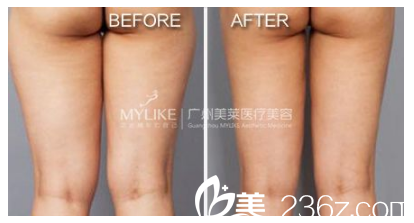 廣州美萊王志軍大腿吸脂案例 廣州美萊王志軍大腿吸脂案例