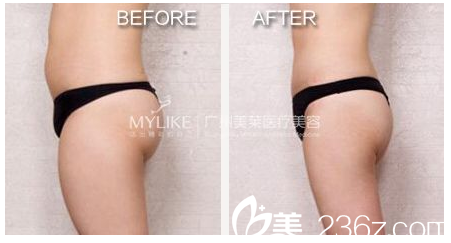 廣州美萊王志軍產(chǎn)后吸脂案例 廣州美萊王志軍產(chǎn)后吸脂案例