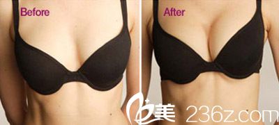 韓國嫵麗整形外科假體隆胸真人案例 韓國嫵麗整形外科假體隆胸真人案例