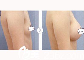 金允石院長假體隆胸前后對比 金允石院長假體隆胸前后對比