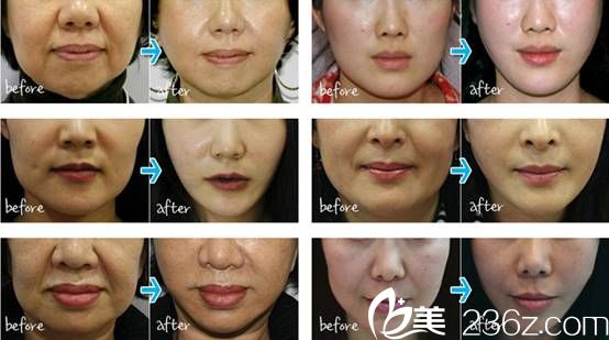 禹政浩院長親自手術(shù)術(shù)后效果 禹政浩院長親自手術(shù)術(shù)后效果