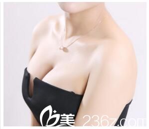 開封華億假體隆胸術(shù)后側(cè)面照