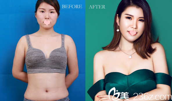 廣州美萊整形醫(yī)院<!--<i data=20240703-sp></i>-->做的內(nèi)窺鏡假體隆胸效果圖