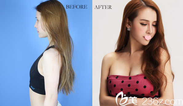 廣州美萊<!--<i data=20240703-sp></i>-->自體脂肪隆胸案例 廣州美萊<!--<i data=20240703-sp></i>-->自體脂肪隆胸案例