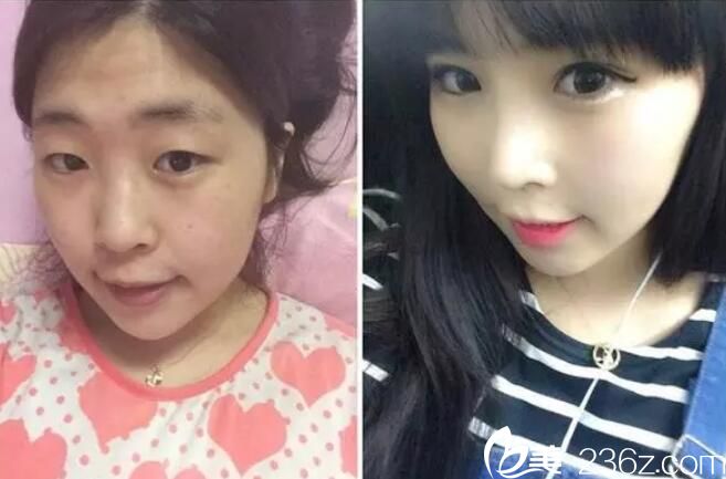 樸鍾喆眼部整形案例 樸鍾喆眼部整形案例