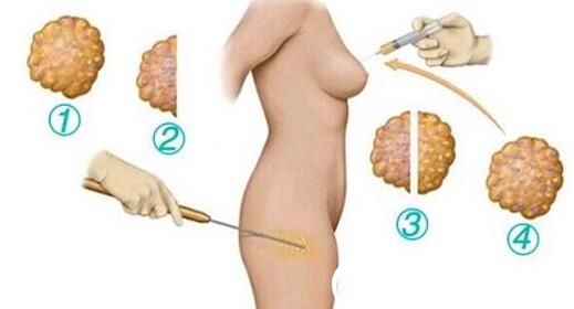 韓國伊美芝整形醫(yī)院自體脂肪移植