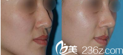 Beauty Line 4U整形外科醫(yī)院案例