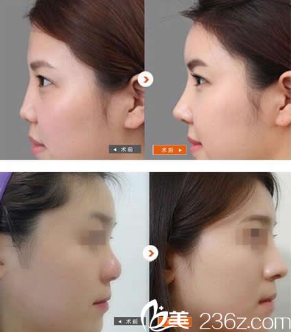 包頭華美隆鼻效果案例 包頭華美隆鼻效果案例