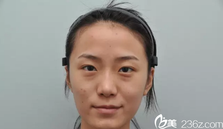 術(shù)前 隆鼻雙眼皮