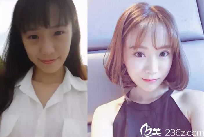 魯峰一隆鼻+鍾喆院雙眼皮真人<span style=