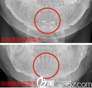 韓國嫵麗面部輪廓整形好不好？看完真人案例你就知道了