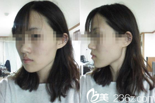 韓國嫵麗整形外科術前素顏照 韓國嫵麗整形外科術前素顏照