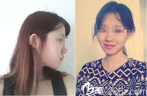 嫵麗醫(yī)院真人案例3周后 嫵麗醫(yī)院真人案例3周后