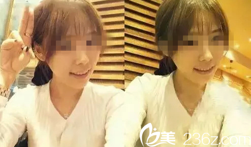嫵麗醫(yī)院術后一個月真人案例 嫵麗醫(yī)院術后一個月真人案例