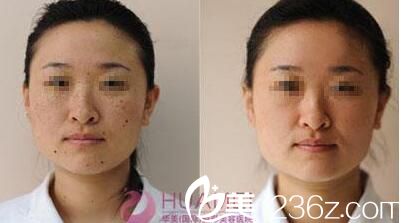 華美岳宏忠激光祛斑效果 華美岳宏忠激光祛斑效果