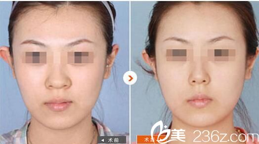 華美王金紅主任隆鼻效果 華美王金紅主任隆鼻效果