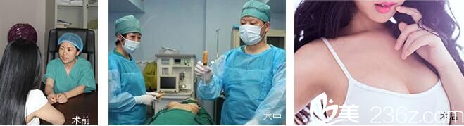 華美朱云醫(yī)生大自然豐胸過(guò)程和效果 華美朱云醫(yī)生大自然豐胸過(guò)程和效果