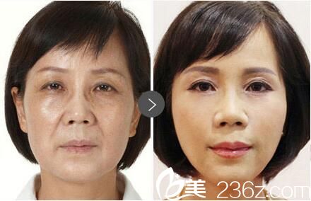 王毅超注射愛貝芙除皺效果 王毅超注射愛貝芙除皺效果