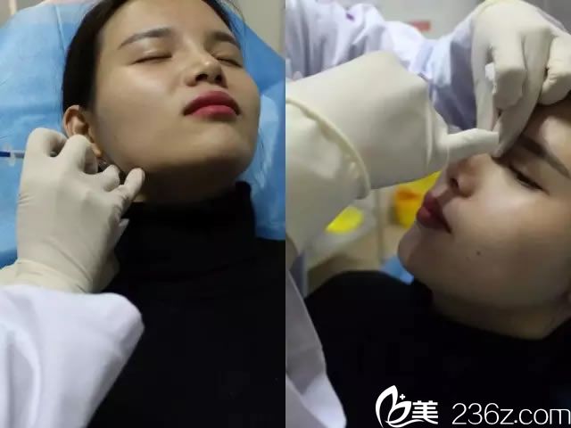 做注射隆鼻和瘦臉的過程圖